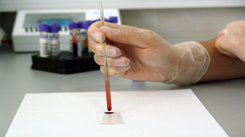 rapid test finds signs of sepsis in single drop of blood rapid test finds signs of sepsis in single drop of blood